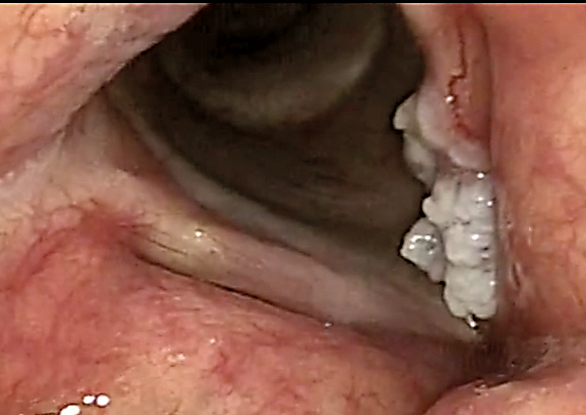 Clinical images by Dr. Guido B. van den Broek
Nijmegen, Netherlands
