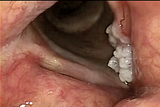 Clinical images by Dr. Guido B. van den Broek
Nijmegen, Netherlands