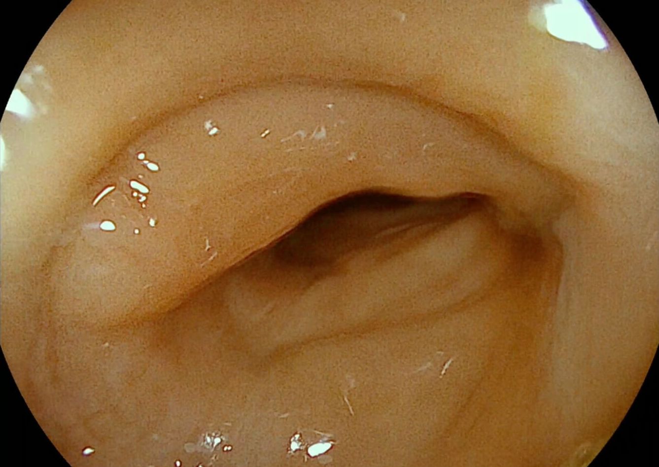 Whitelight endoscopy with EC38-i20c