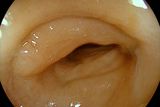 Whitelight endoscopy with EC38-i20c