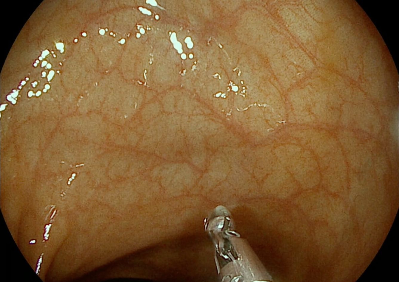 clinical image i20c showing whitelight image quality