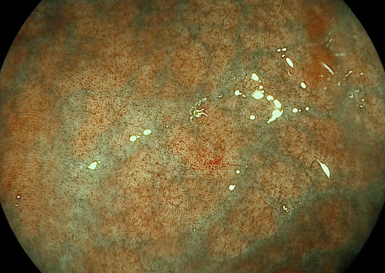 clinical image showing the i-scan optical enhancement with EC38-i20c
