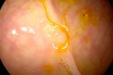 Insufficient bowel preperation, Dr. Albert Beyer, private practice Altöttingen, Germany