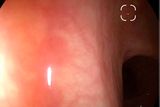 Polyps off-center, out of focus, Dr. Albert Beyer, private practice Altöttingen, Germany