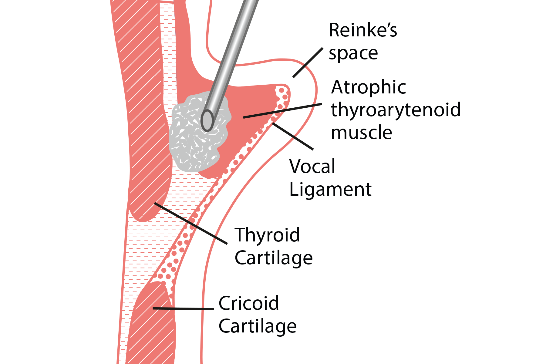illustration of a thyroid with a catheter being injected