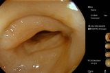 Whitelight endoscopy with EC38-i20c