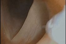 exposed needle for injection