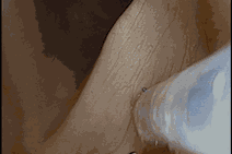 wider view of vocal fold