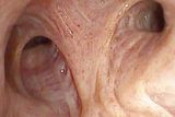 Image taken with EB-J10 and DEFINA video proecessor, HD image: right upper lobe, Prof. Erik van der Heijden, Radboud University Medical Center, Nijmegen Netherland