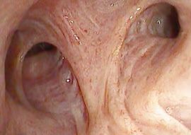 Image taken with EB-J10 and DEFINA video proecessor, HD image: right upper lobe, Prof. Erik van der Heijden, Radboud University Medical Center, Nijmegen Netherland. (Image for illustrative purposes only)