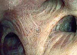 Image taken with EB-J10 and DEFINA video proecessor, i-scan 2 image right upper lobe, Prof. Erik van der Heijden, Radboud University Medical Center, Nijmegen Netherland. (Image for illustrative purposes only)